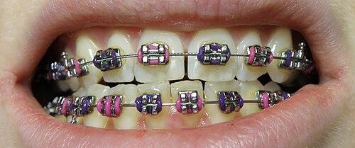 Dental Braces in Kakinada