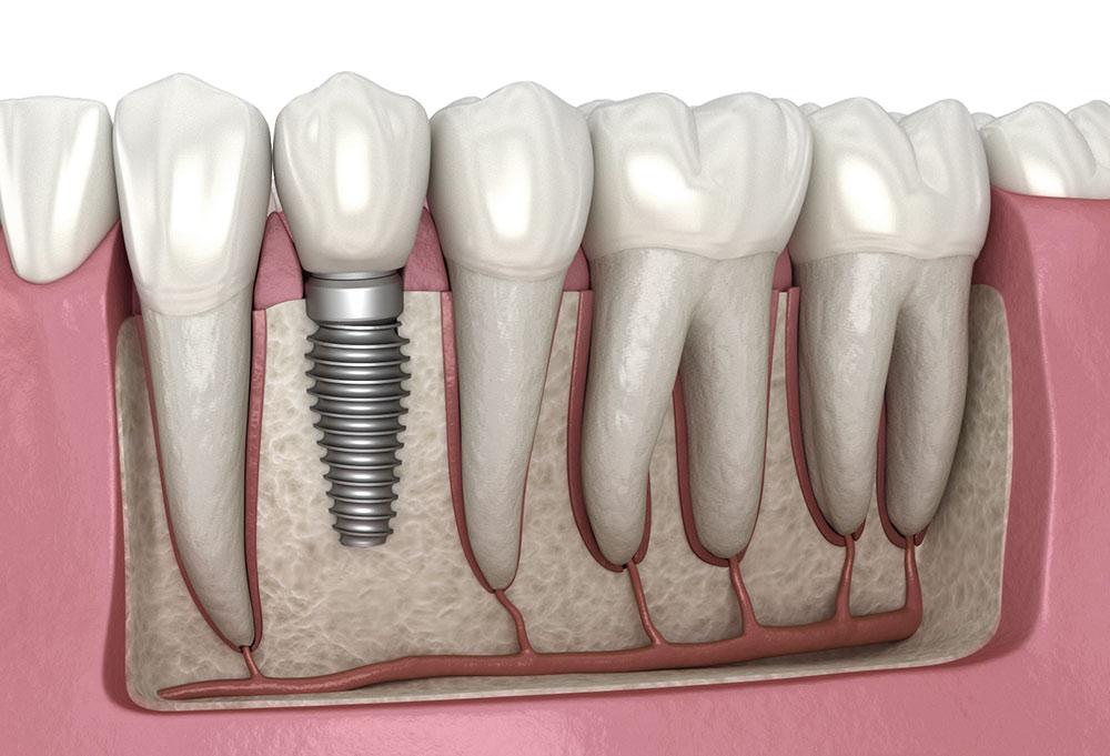 Dental Implants in Kakinada