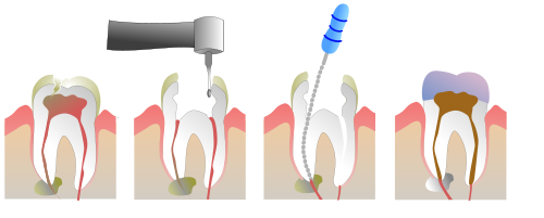 Root Canal Treatment in Kakinada