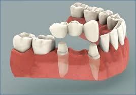 Dentures