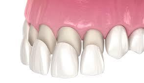 Porcelain Veneers