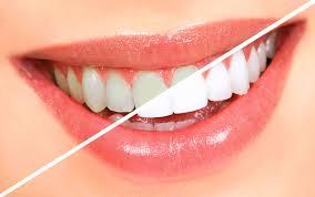 Teeth Whitening in Kakinada